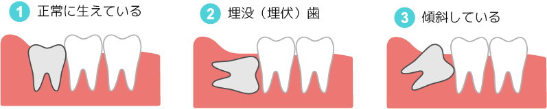 親知らずのタイプ