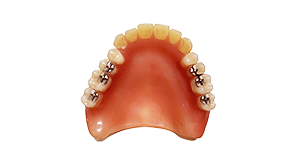 スマートデンチャー